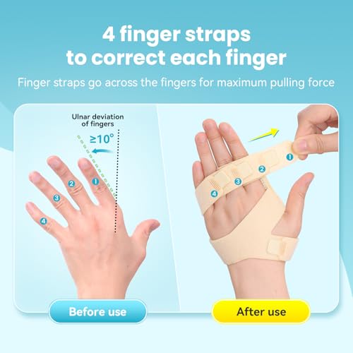 DrFinger Finger Ulnar Deviation Splint Brace, Finger Joint Deviation Orthopedic Corrector With Metal Bracket-Beige-Right(L/XL)