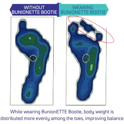 BunionETTE Bootie Tailor Bunion Corrector for Women & Men, Toe Spreader for Tailor Bunion, Bunionette Corrector, Bunionette Relief Socks, Bunionette Protector, Bunionette Spacer Splint - Medium, Left