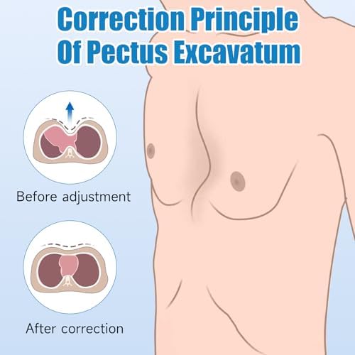 Pectus Excavatum Brace Pectus Excavatum Vacuum Bell Pectus Excavatum Orthosis Sternum Brace Chest Brace for Kids Men Women (Small)