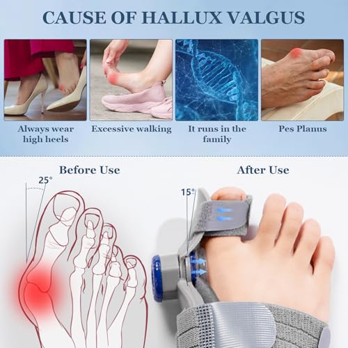 Bunion Corrector for Women & Men,Treatmedy Bunion Fix,Adjustable Toe Straightener - Orthopedic Bunion Splint for Big Toe Alignment, Hallux Valgus Correction, Left/Right Feet Relief (1PCS)