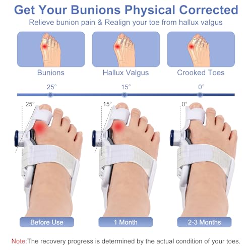 Adjustable Bunion Corrector for Women Big Toe Bunion Corrector for Men Adjustable Fit for All Foot Sizes (White)