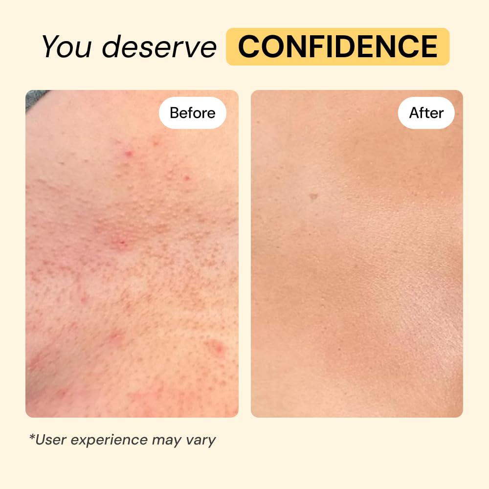 MyMagicHealer Universal Flare Care – Multi-Purpose Solution | Skin Flare-Ups - Hidradenitis Suppurativa, Folliculitis, Boils, Cysts | Anti-Chafing | Irritated Skin Relief w/Propolis & Egg Yolk 1 oz