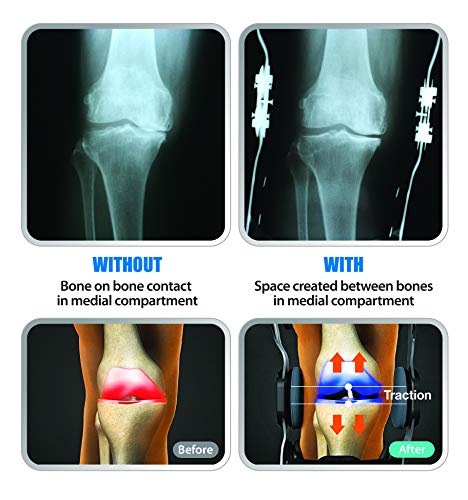 DDS, Inc. OA Pro Decompression Knee Braces - Arthritis Knee Support for Degeneration, Meniscus Tear, Bone-on-Bone Pressure Relief - Dual Unloading for Medial & Lateral Stability (XLarge)