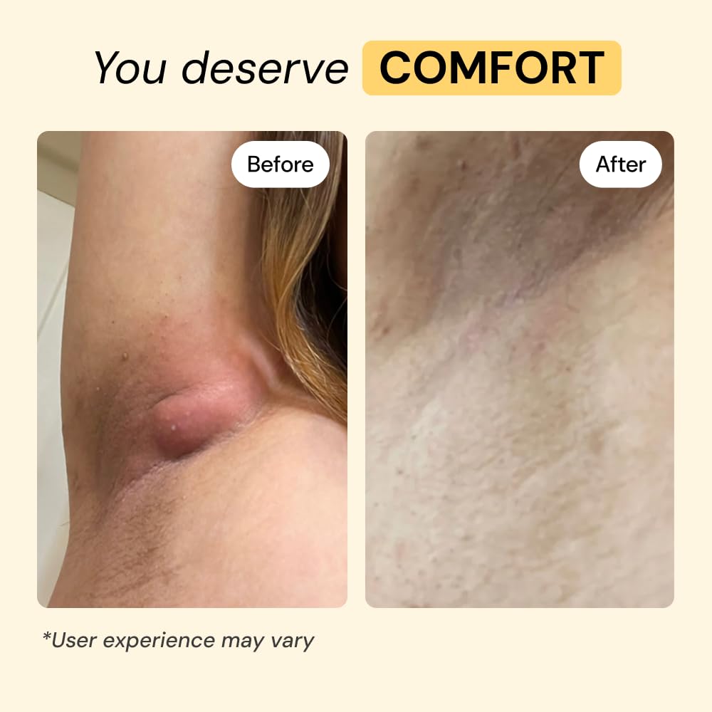 MyMagicHealer Universal Flare Care – Multi-Purpose Solution | Skin Flare-Ups - Hidradenitis Suppurativa, Folliculitis, Boils, Cysts | Anti-Chafing | Irritated Skin Relief w/Propolis & Egg Yolk 1 oz