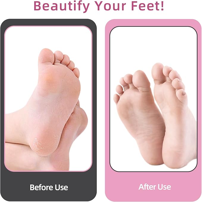 APRELM Electric Foot Callus Remover with 80pcs Sandpaper Discs, 4.8IN Longer Professional Callus Remover for Feet, Pedicure Tools Foot File for Dead Skin