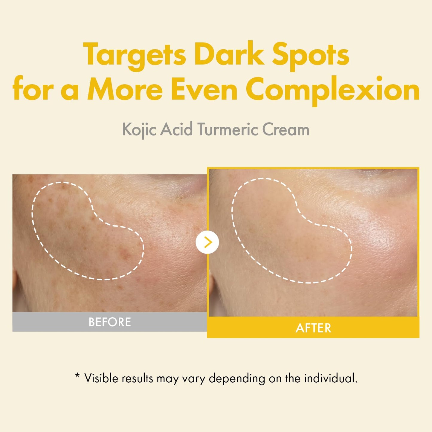 TOSOWOONG Kojic Acid Turmeric Cream, 99% Purity Kojic Acid 7,000ppm, 660,941ppm Turmeric, Dark Spot Corrector Capsule for Hyperpigmentation & Even Skin Tone Care, Korean Skincare, 50ml / 1.69 fl. oz.