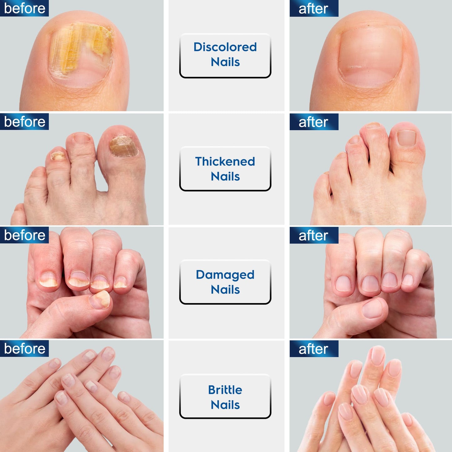 Advanced Toenail Fungus Treatment – Helps Reduce Thick, Yellow Nails & Maintain Healthier Toenails Over Time, Toe Nail Fungus Treatment Extra Strength 2pcs x15ml.