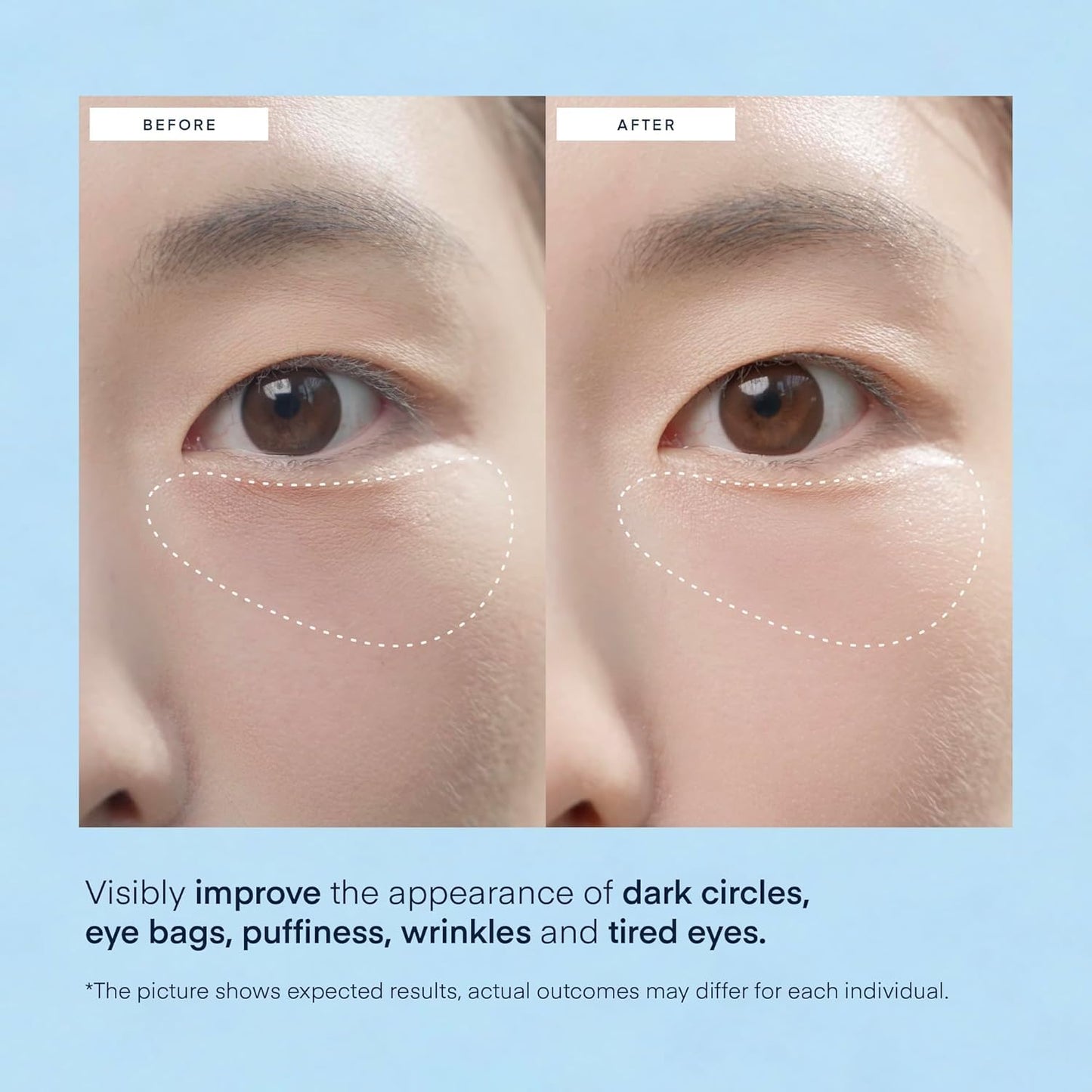 Terez & Honor Under Eye Patches for Dark Circles - 60 Korean Hydrogel Masks for Puffiness, Bags, Wrinkle with Caffeine, Hyaluronic Acid, Niacinamide - Undereye Hydrating & Cooling, Vegan, No Fragrance
