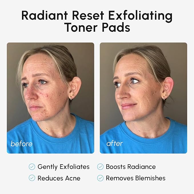 MAREE Glycolic Acid Pads Ã¢ÂÂ Toner Pads for Face Cleansing Ã¢ÂÂ Exfoliating Pad with Tea Tree Oil, Salicylic Acid & Vitamins E, B3, B5 Ã¢ÂÂ Acne Clearing, Skin Pore Resurfacing & Radiance Device - 80 Count