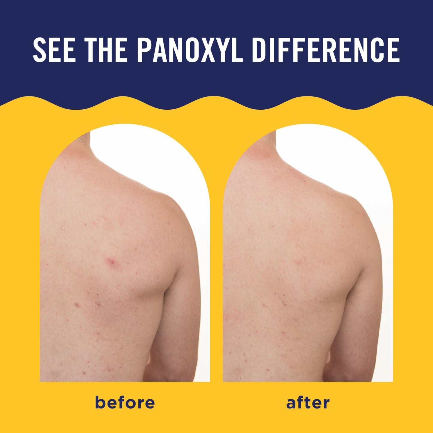 PanOxyl Acne Banishing Body Spray with 2% Salicylic Acid, Pimple Treatment Spray to Clear Stubborn Breakouts, 360-Degree Spray Nozzle, Skin-Brightening Niacinamide, Vitamin C, Witch Hazel, Aloe, 6 Oz