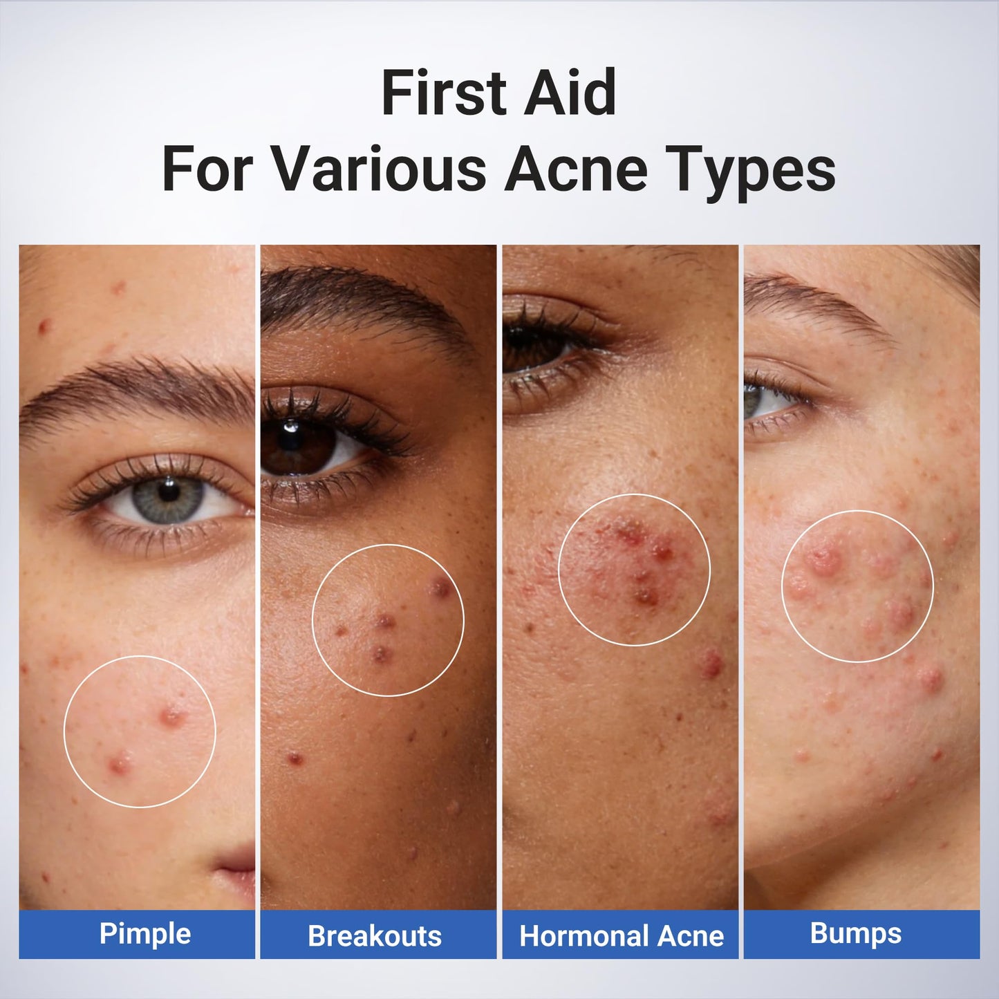 Dr.Leo 1.8% Salicylic Acid Spot Serum, Acne drying lotion Treatment for Acne-Prone Sensitive Skin | Niacinamide, Fast Pimple Relief, Fades Acne Marks, Overnight & Period Breakouts, 0.34 fl oz (20 ml)