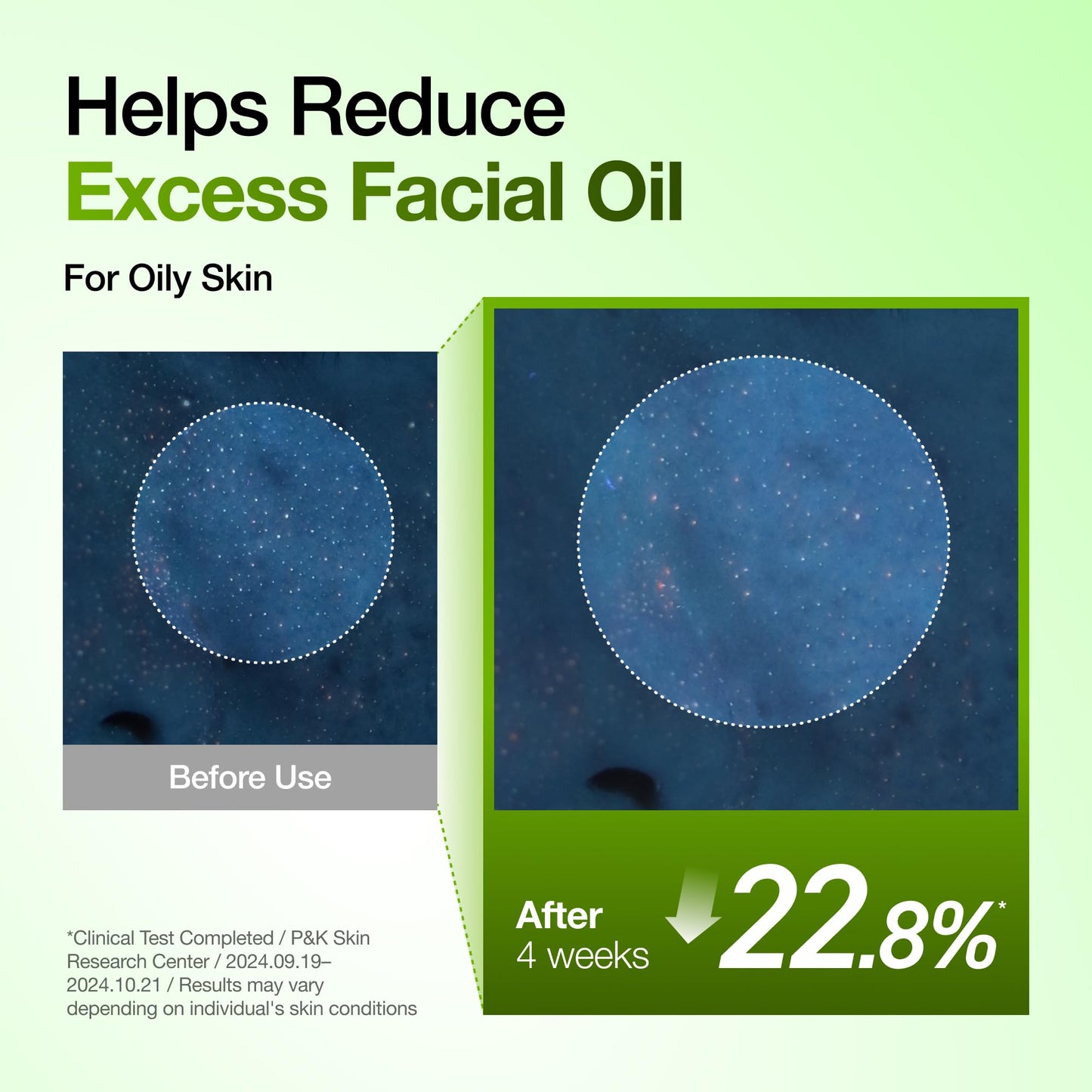 Anua Azelaic Acid 10 Hyaluron Redness Soothing Serum, Facial Serum for Blemish-Prone & Oily-Prone Skin, Lightweight & Hydrating Blemish Care, Hyaluronic Acid, Korean Skincare, 1.01 fl oz.