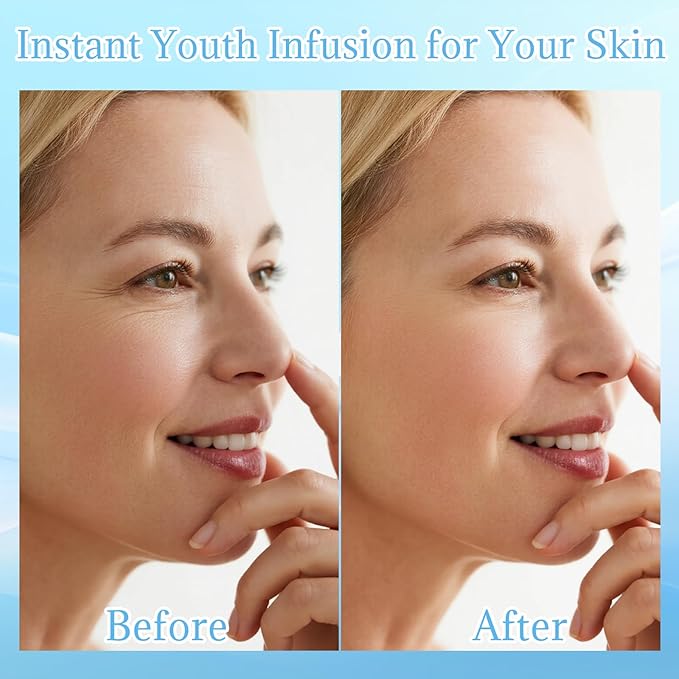 Micro Needling Kit for Face - Micro Infusion System for Face with Hyaluronic Acid & Collagen - Moisturizing & Anti-Wrinkle Facial Serum for All Skin Types - 1 Roller + 4 Serums