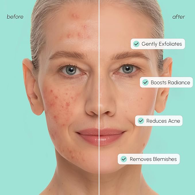 MAREE Azelaic Acid Acne Clearing Pads Ã¢ÂÂ Exfoliating Pads with Glycolic & Hyaluronic Acid for Face Ã¢ÂÂ 10% Azalecic Acid & Centella Redness Soothing Pad Ã¢ÂÂ Zero Pore Facial Toner Pad Ã¢ÂÂ Acido Azelaico