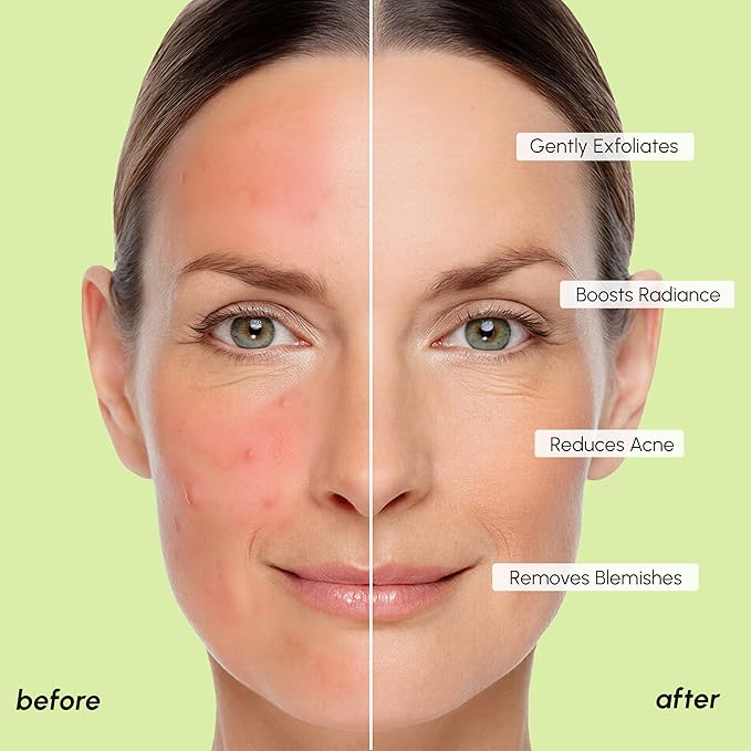 MAREE Blemish Acne Clearing Polishes - Daily Facial Radiance Toner Pads - Witch Hazel Pads Acne Face Toning - Acne Skin Care with BHA Salicylic Acid - Blemish Clearing Witch Hazel Device