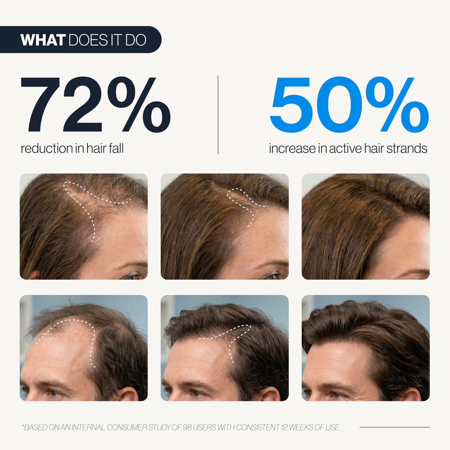 Be Bodywise Hair Growth Serum Roll On - 5% Saw Palmetto, 3% Rosemary Oil for Hair Growth, 3% Fenugreek,1% Caffeine Herbasome | Serum for Hair Loss & Hair Regrowth For Men & Women 25ml/0.84 fl oz