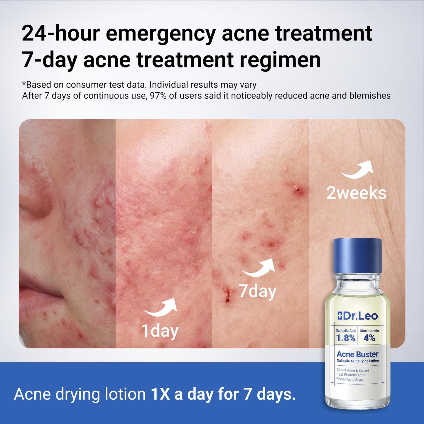 Dr.Leo 1.8% Salicylic Acid Spot Serum, Acne drying lotion Treatment for Acne-Prone Sensitive Skin | Niacinamide, Fast Pimple Relief, Fades Acne Marks, Overnight & Period Breakouts, 0.34 fl oz (20 ml)