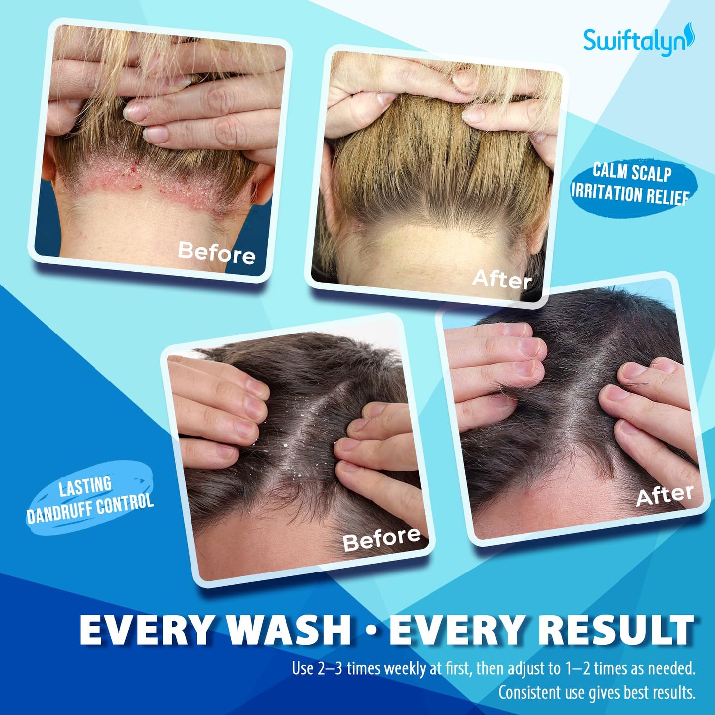 Swiftalyn Scalp Ance Shampoo for Men & Women – Sulfate-Free Formula